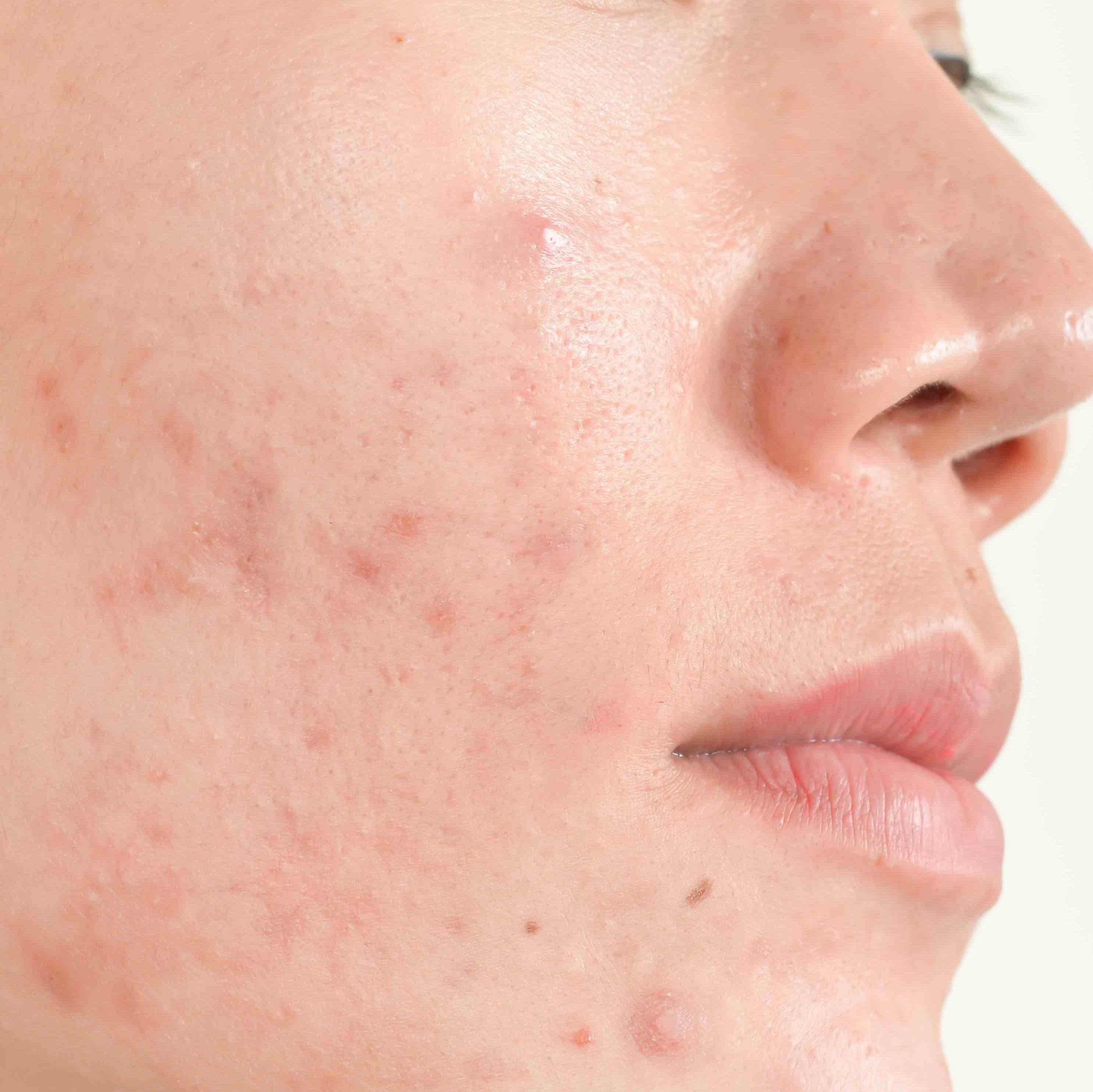 Acne resource