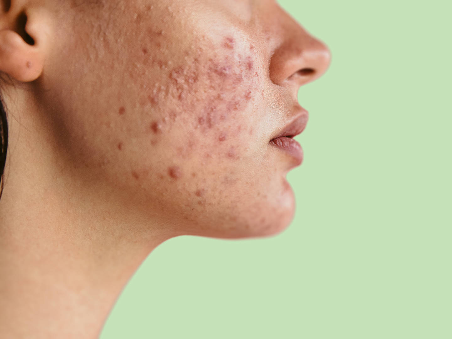Acne