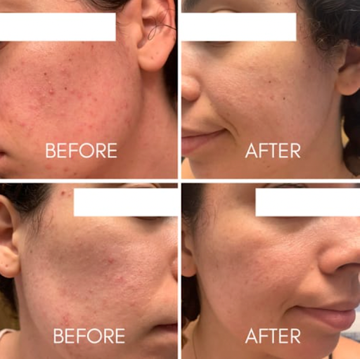 The Acne Protocol