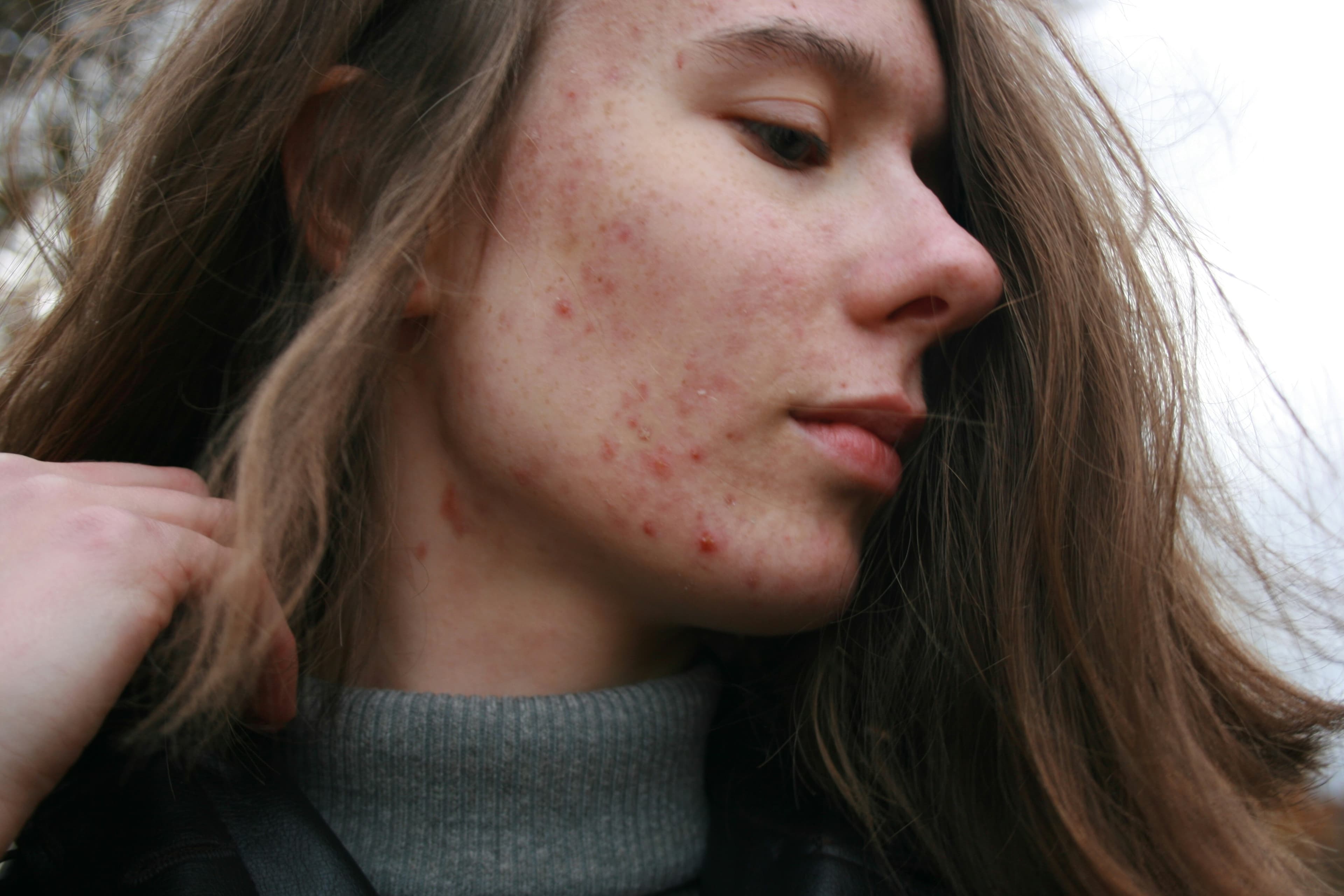 Panoxyl vs. CeraVe: The Best Acne Face Wash for Your Skin Type