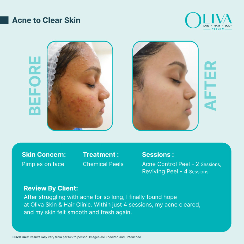 The Acne Protocol