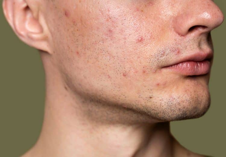 Creatine acne