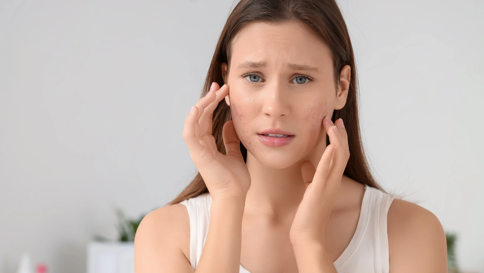 Creatine acne