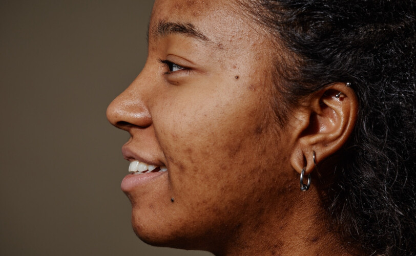Best Acne Face Washes for 2026: A Practical Acne Resource