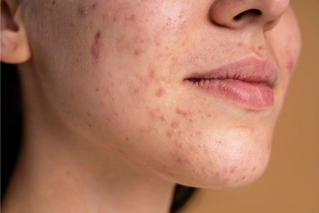 Creatine acne