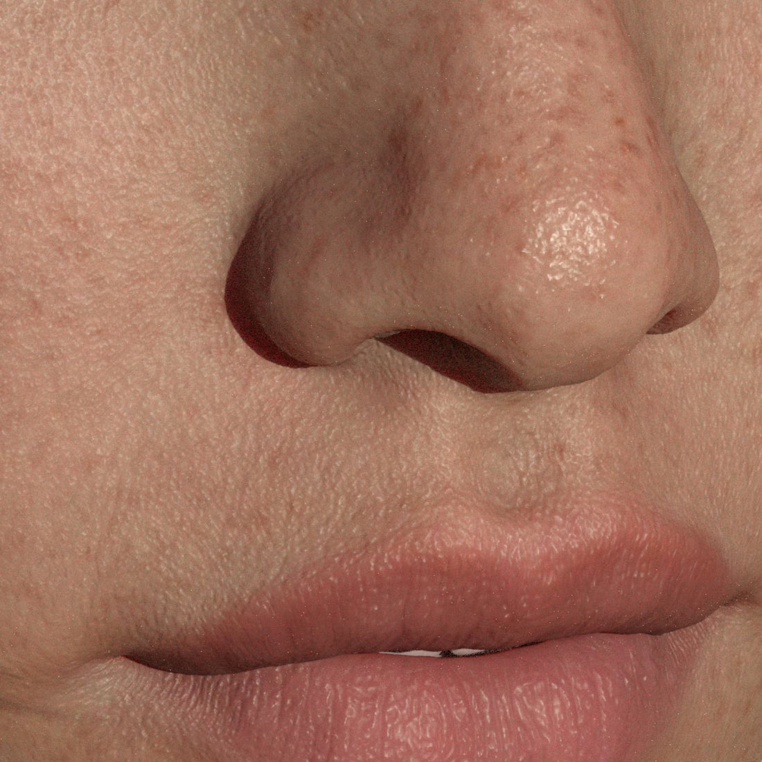 Creatine acne