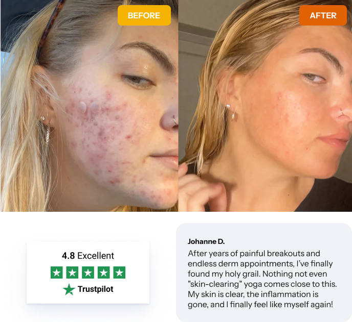 Creatine acne