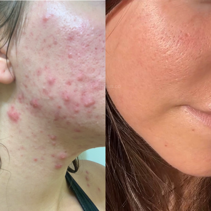 Creatine acne