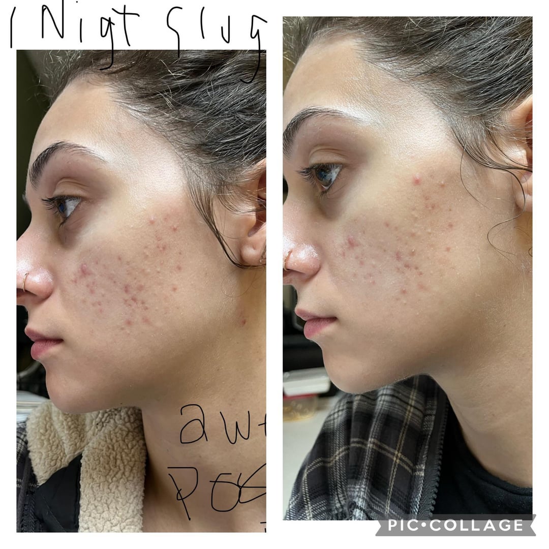 TikTok's Viral 'Slugging' Trend: Does Petroleum Jelly Really Clear Acne in 2026?