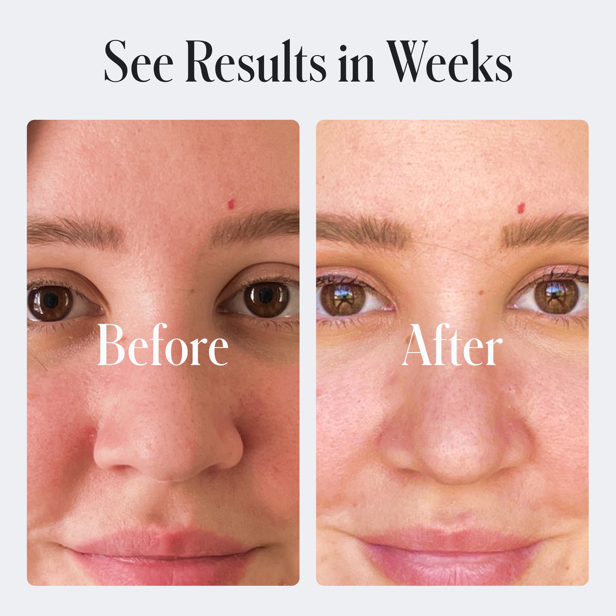 acne face wash