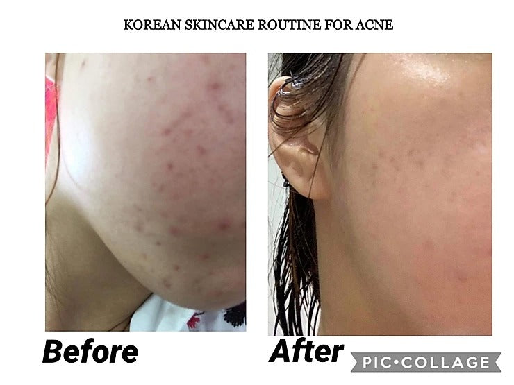 Panoxyl vs CeraVe Acne Wash: Which Best Acne Face Wash Fits Your Skin?
