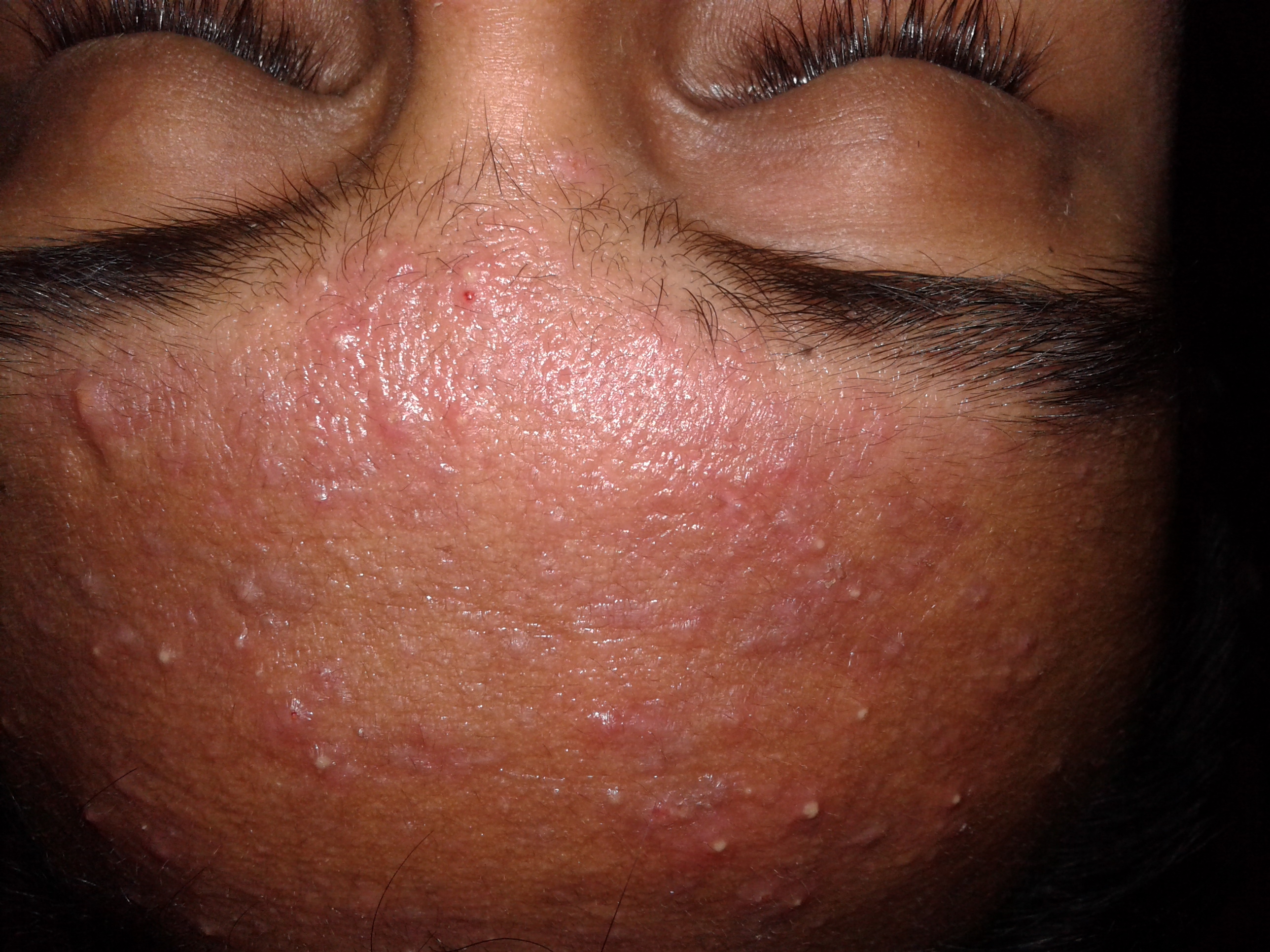Creatine Acne Explained: Top Face Washes and Treatments