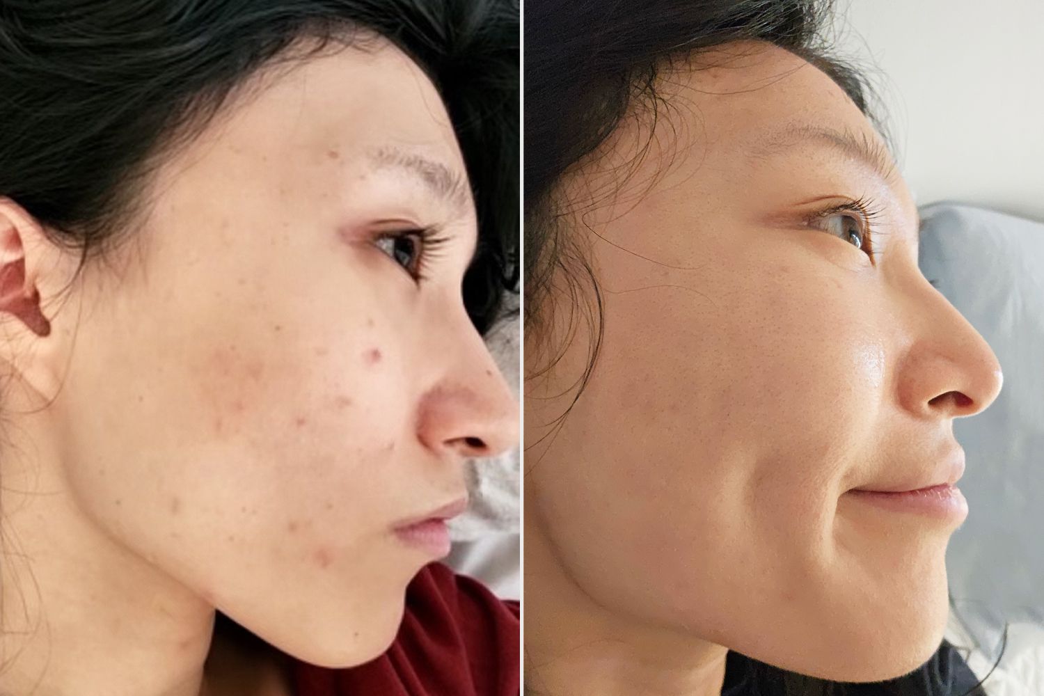 Acne Lifestyle Factors: How Creatine and Cannabis Affect Your Skin