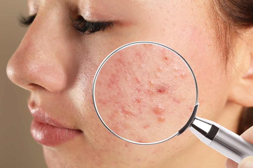 Acne lifestyle factors