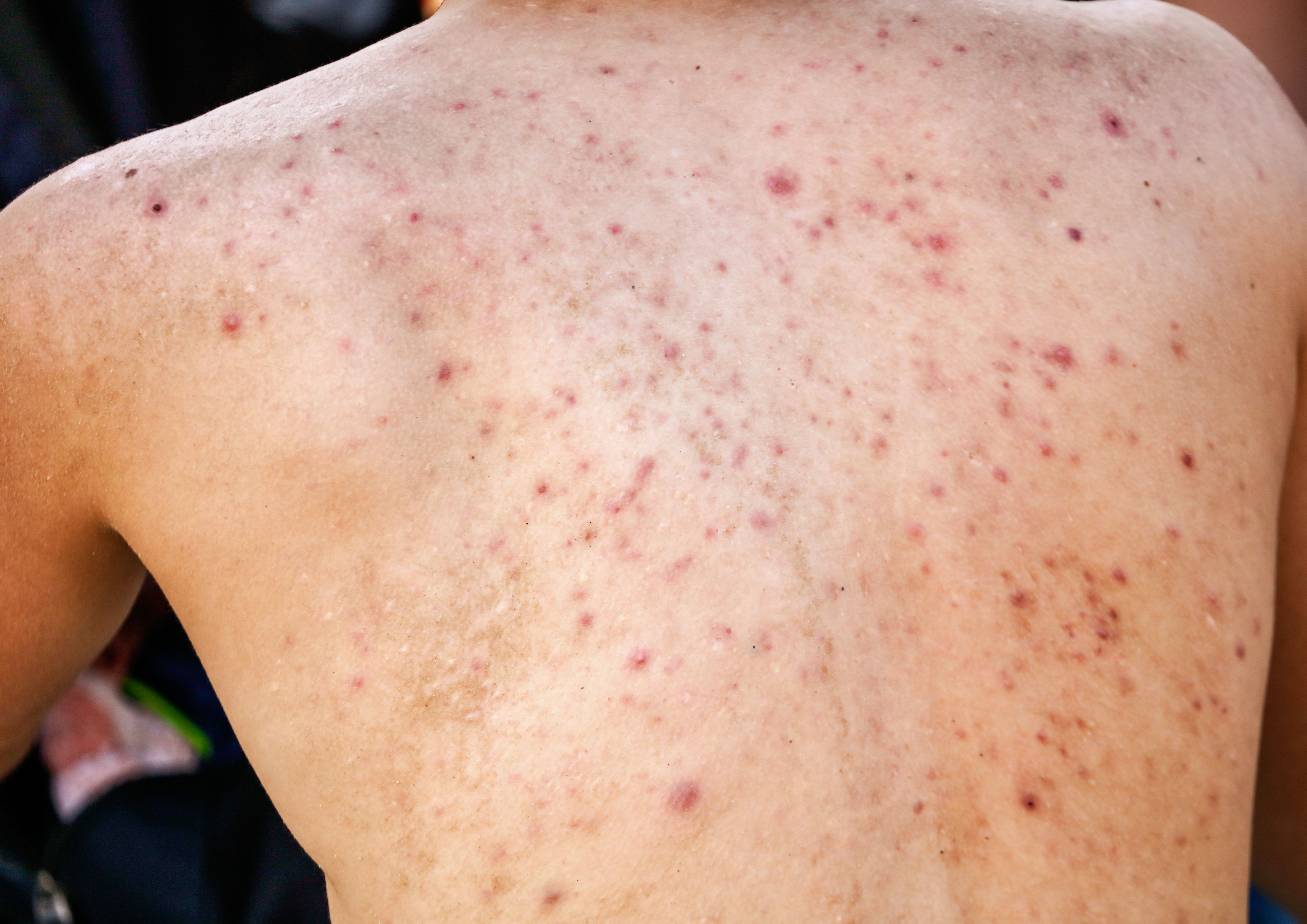 Acne lifestyle factors