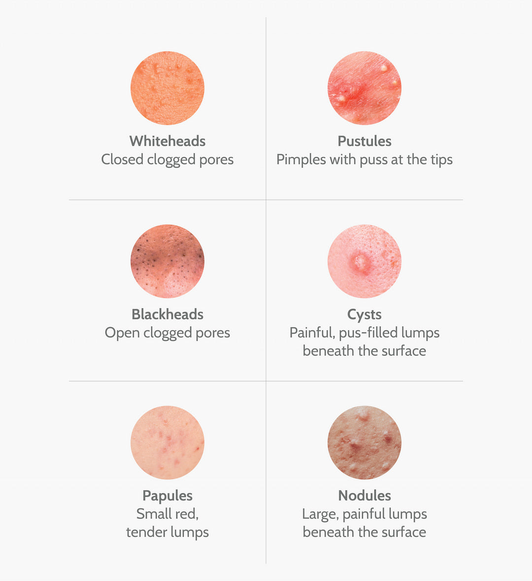 Acne lifestyle factors