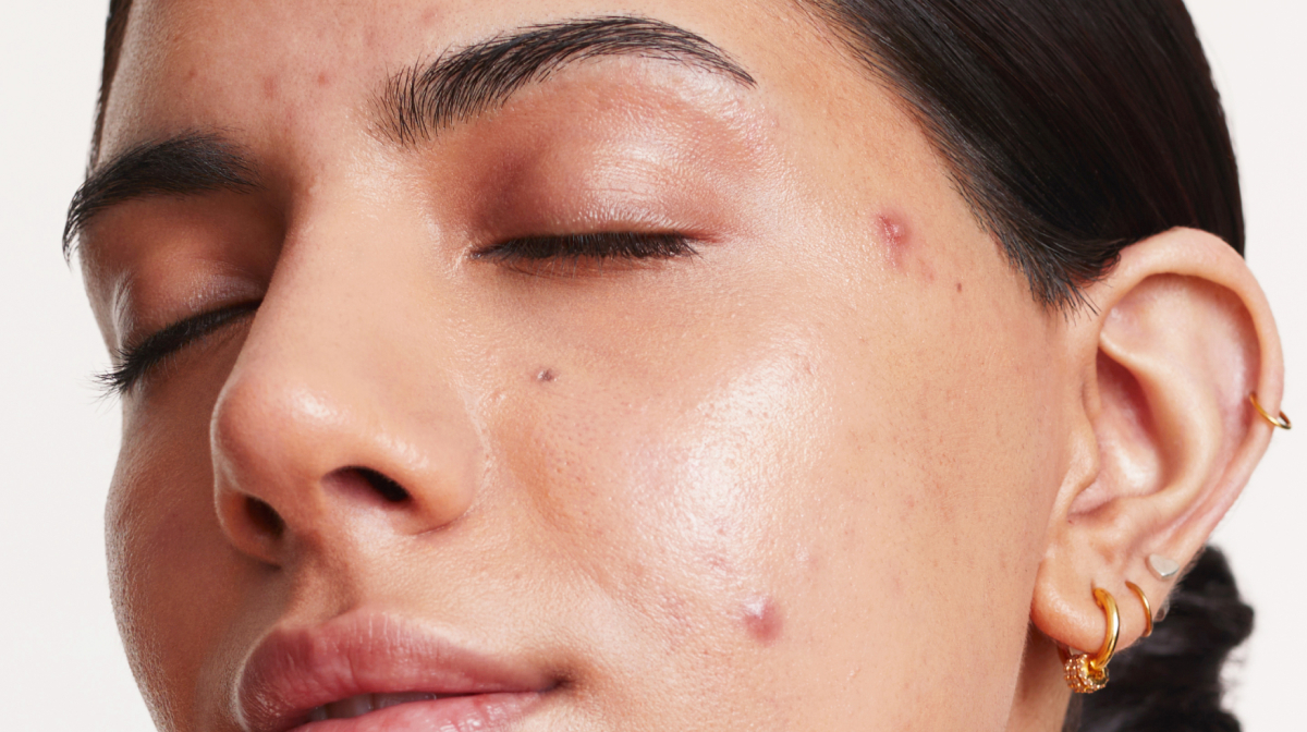 Acne lifestyle factors