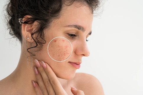 Acne Lifestyle Factors: Cutting Creatine, Weed, and Sugar for Clearer Skin