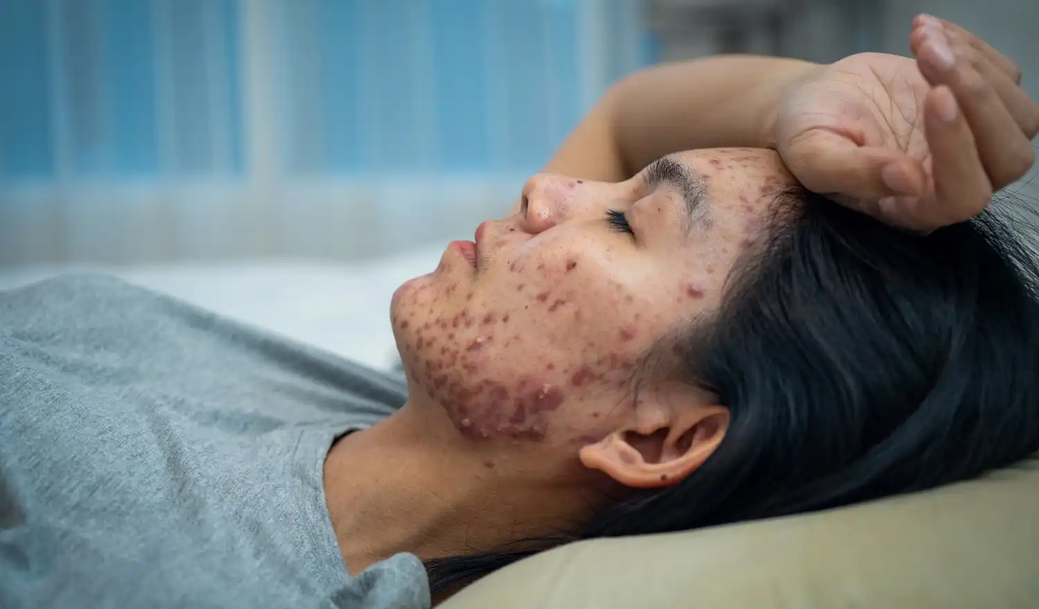 Acne lifestyle factors