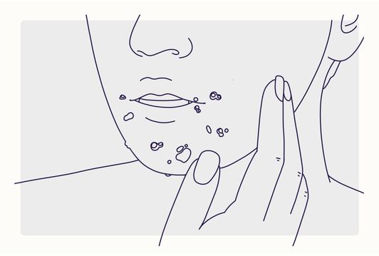 2026 guide: Does Creatine & Weed Cause Acne? Best Cleansers (Panoxyl, CeraVe) & Laser Treatments to Clear Skin
