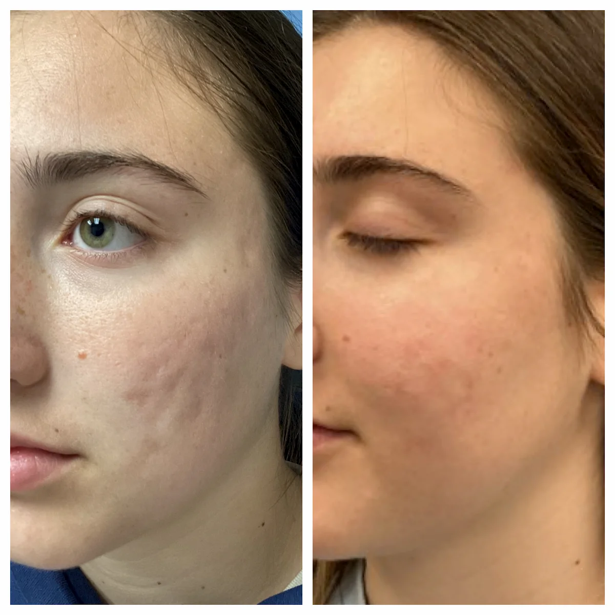 Acne resource