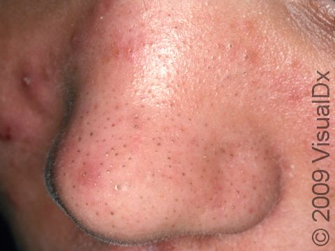 Acne Resource: How to Treat Breakouts with Panoxyl, CeraVe, and Lifestyle Changes
