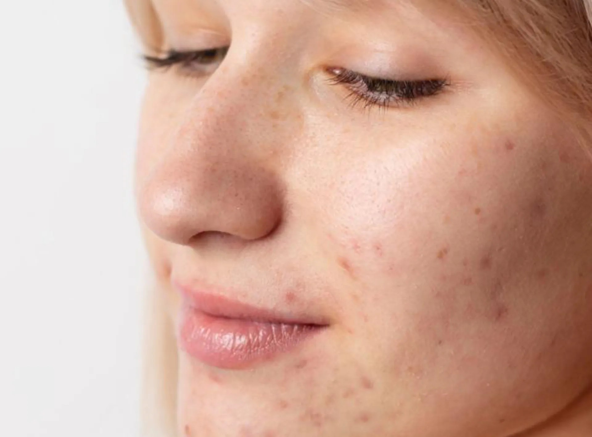 Acne Survival