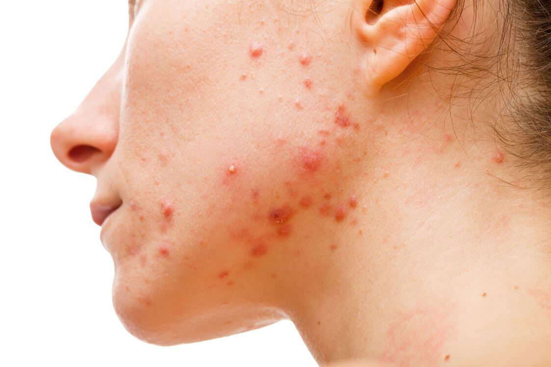 Acne resource