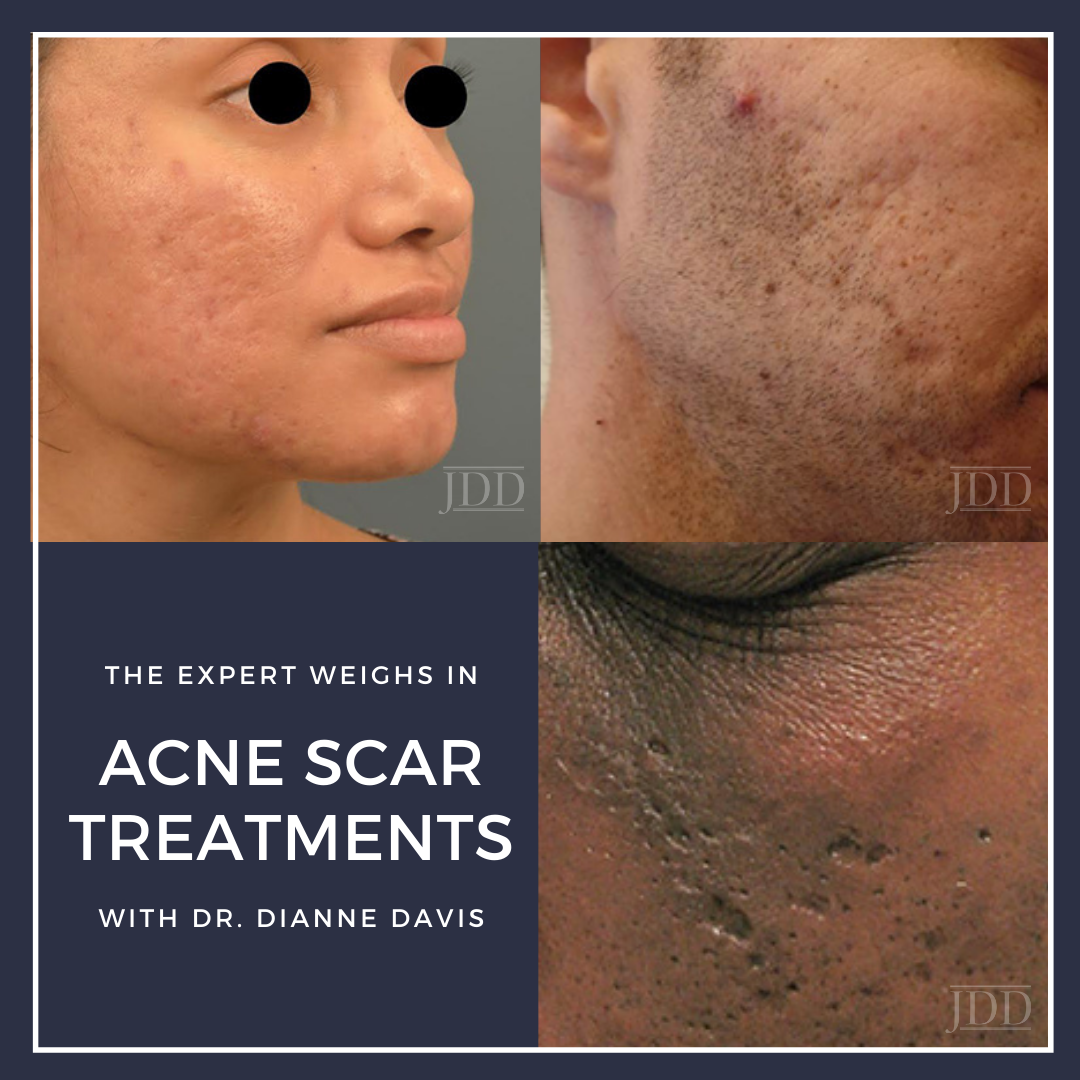 Acne resource
