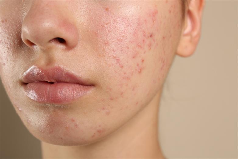 Acne