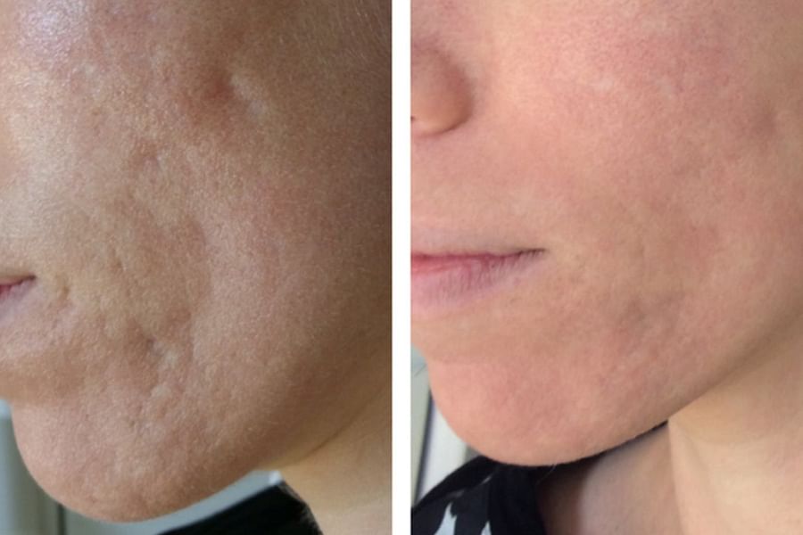 dermatological acne scar treatments