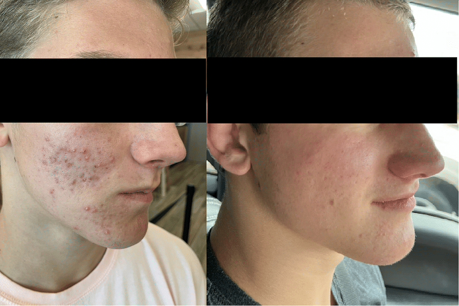 prescription acne scar treatments
