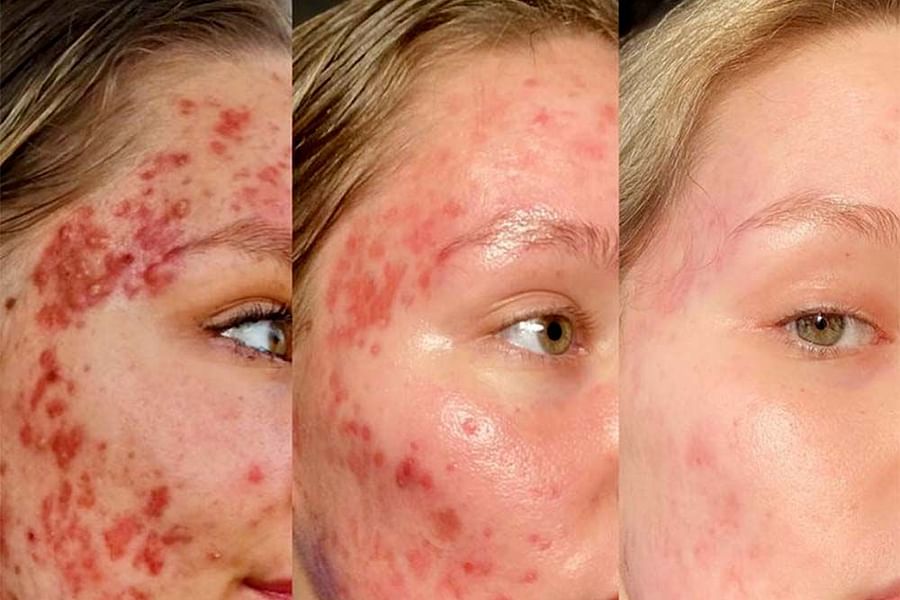 Isotretinoin acne treatment