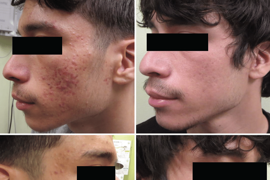 Laser Acne Treatment