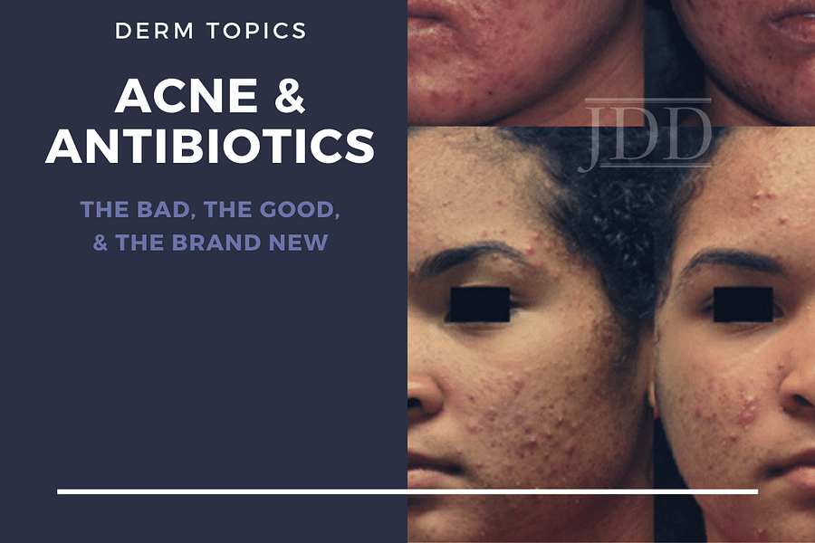 Oral antibiotics for acne