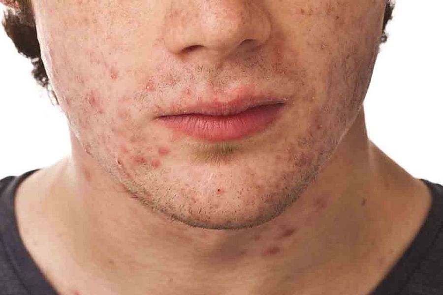 poor hygiene acne