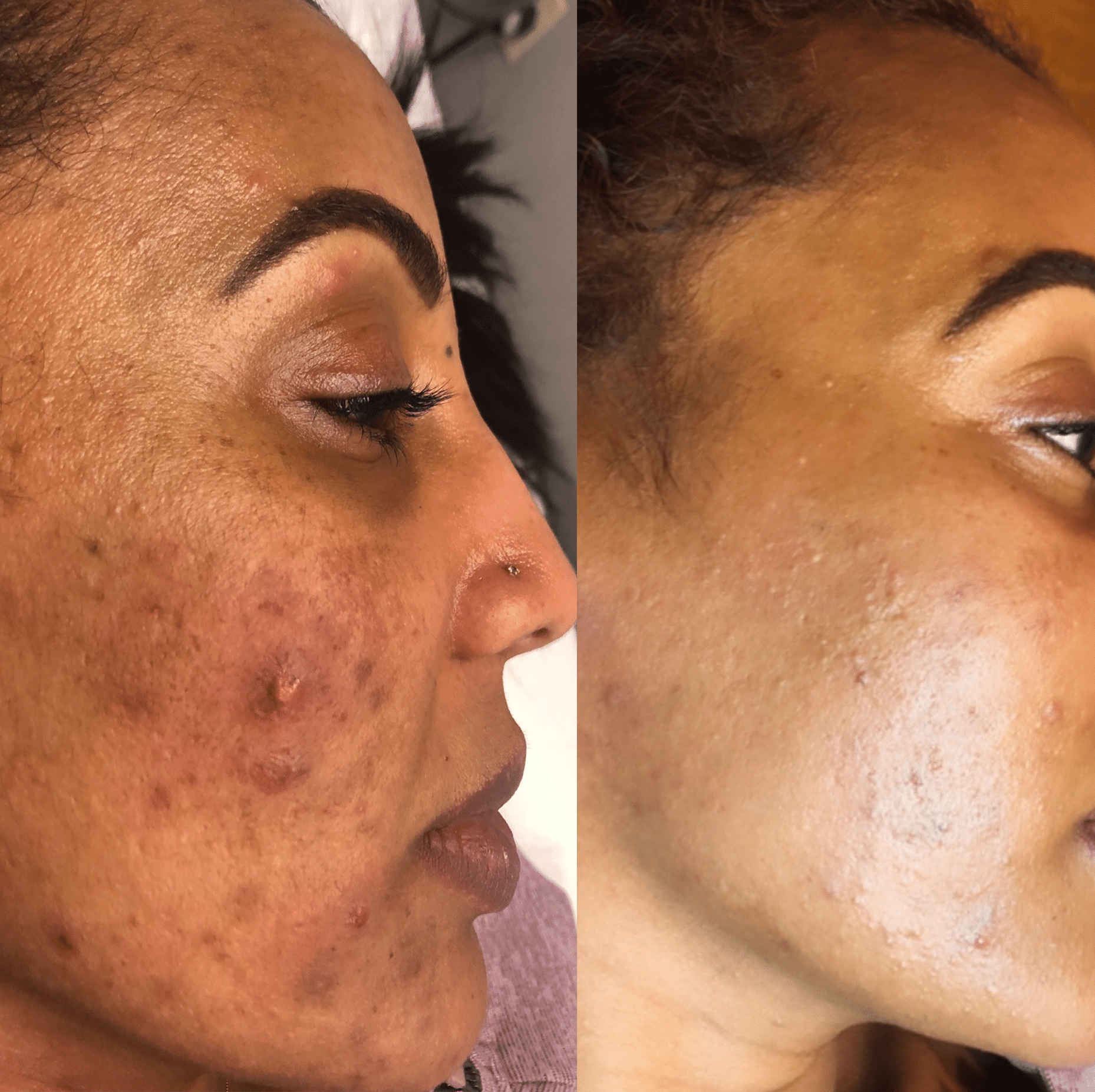 laser acne treatment recovery