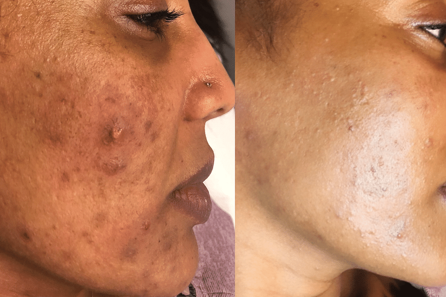 laser acne treatment recovery