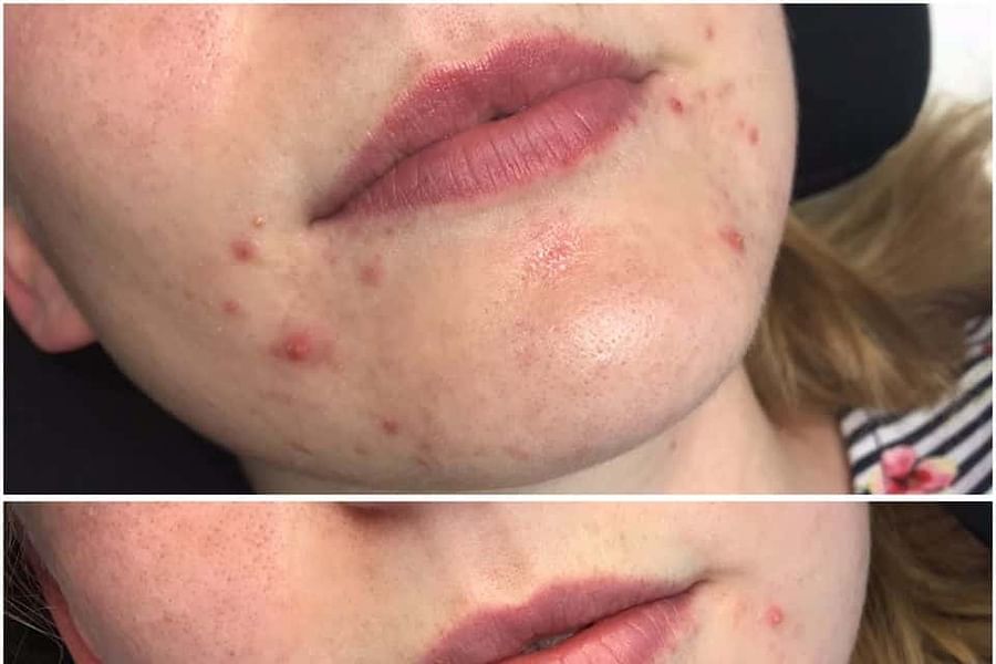 laser acne treatment side effects