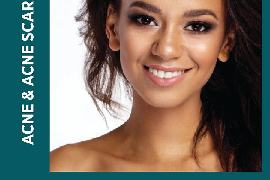 precision laser acne treatment