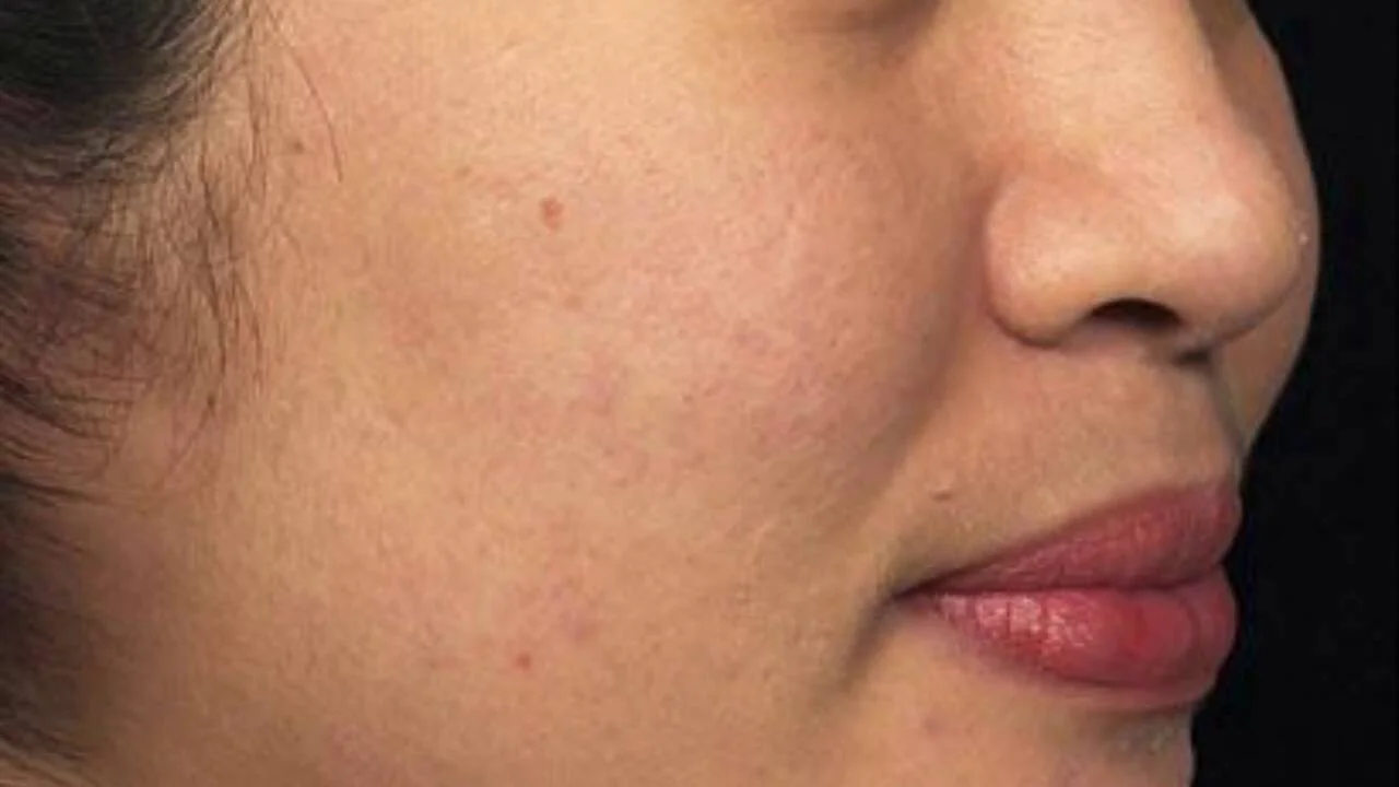 quick laser acne session