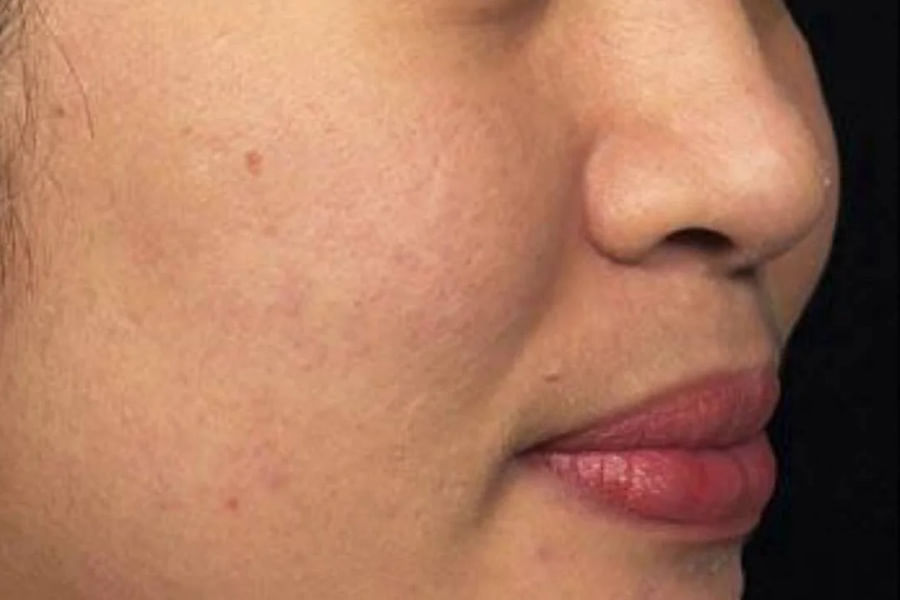 quick laser acne session