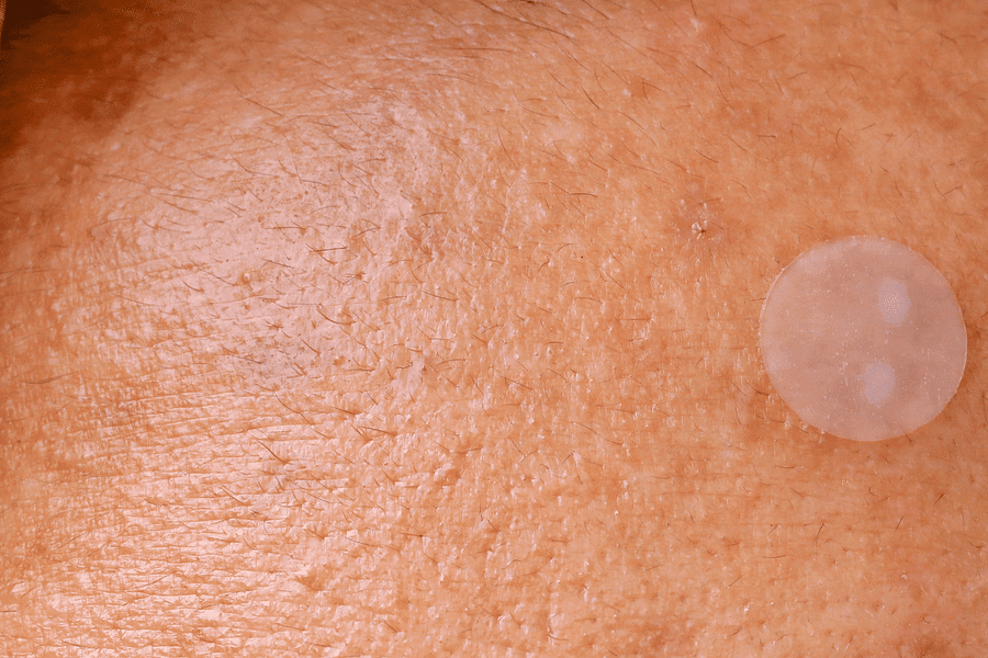 pimple patch prevent picking