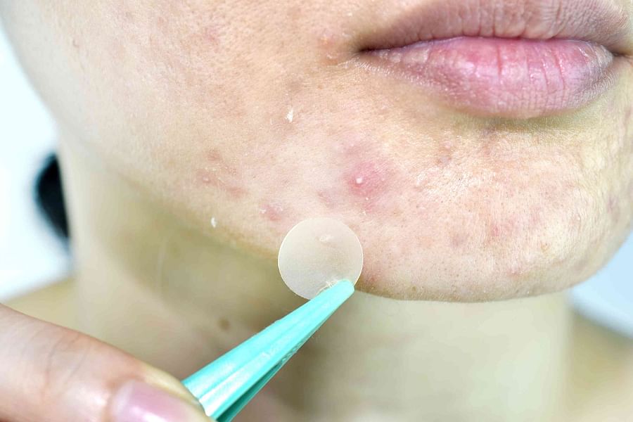 translucent hydrocolloid acne patch