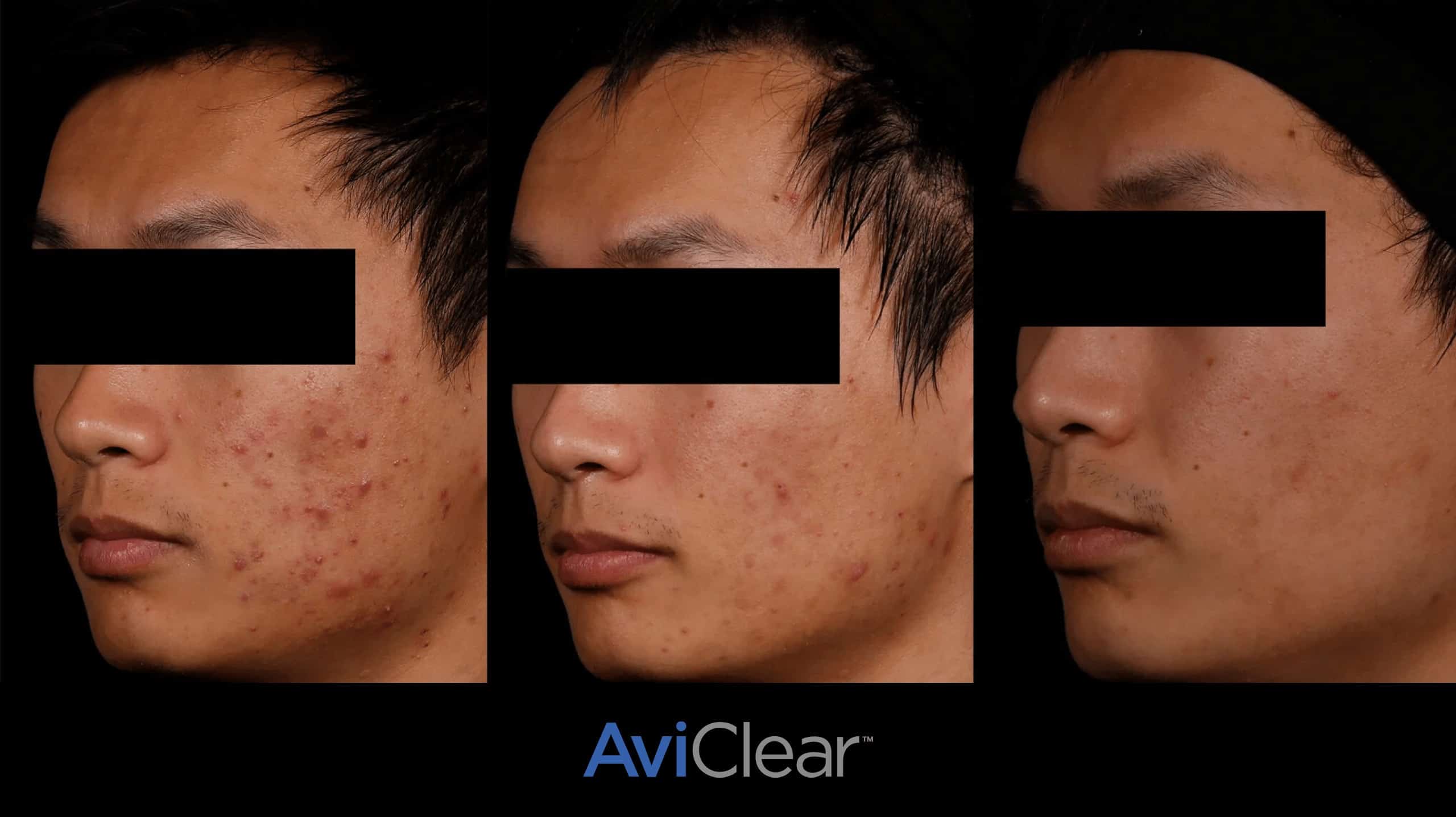 AI personalized acne treatment