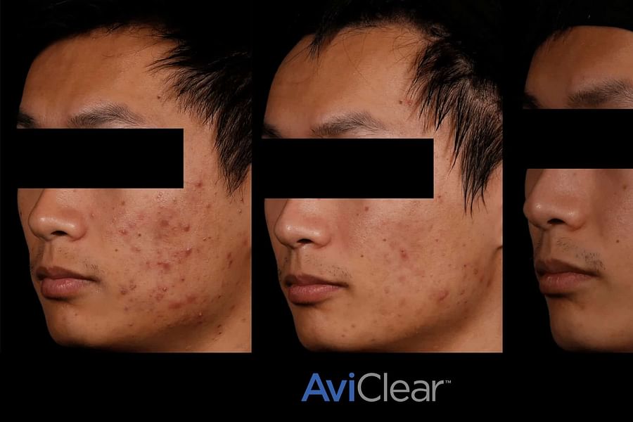 AI personalized acne treatment