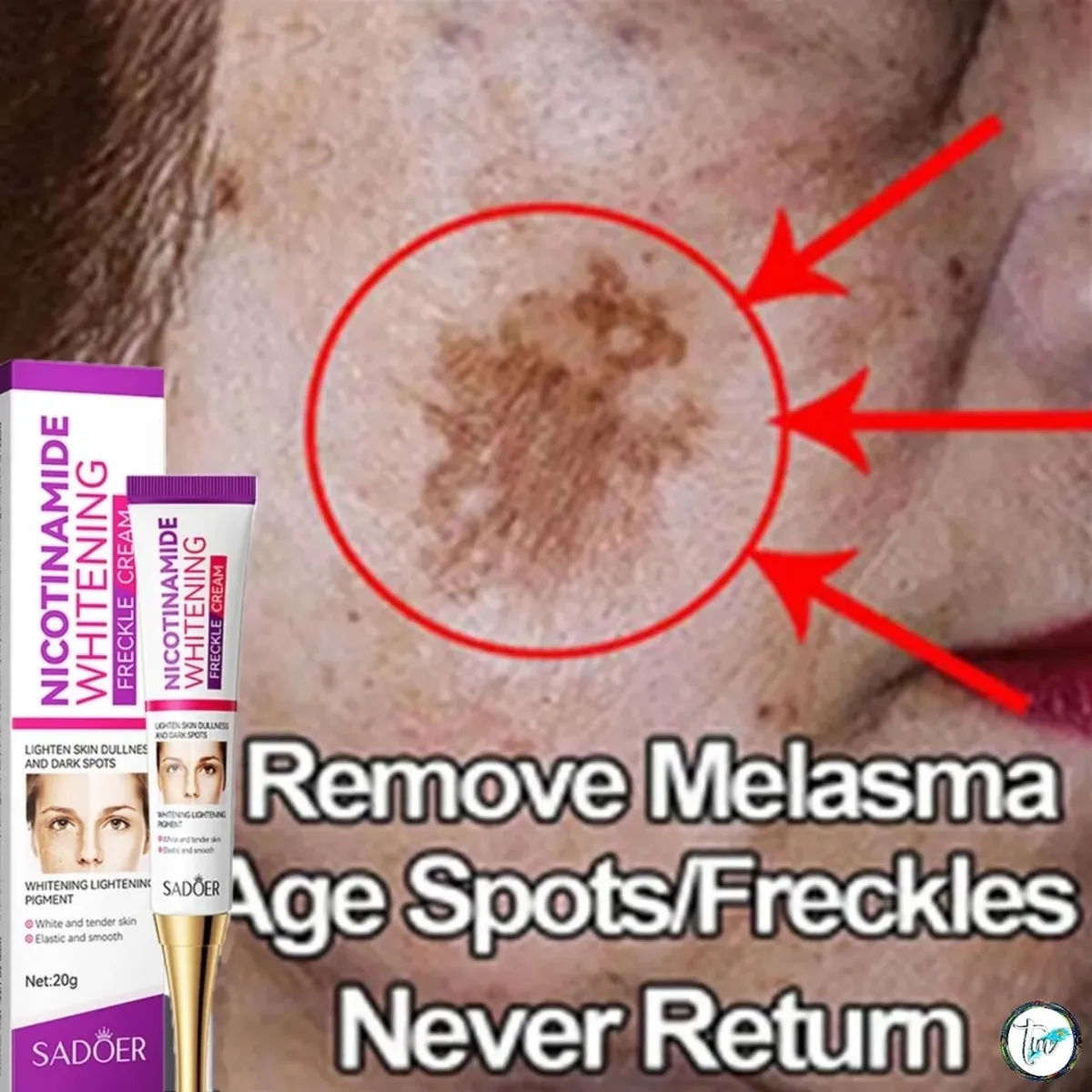 nicotinamide acne treatment