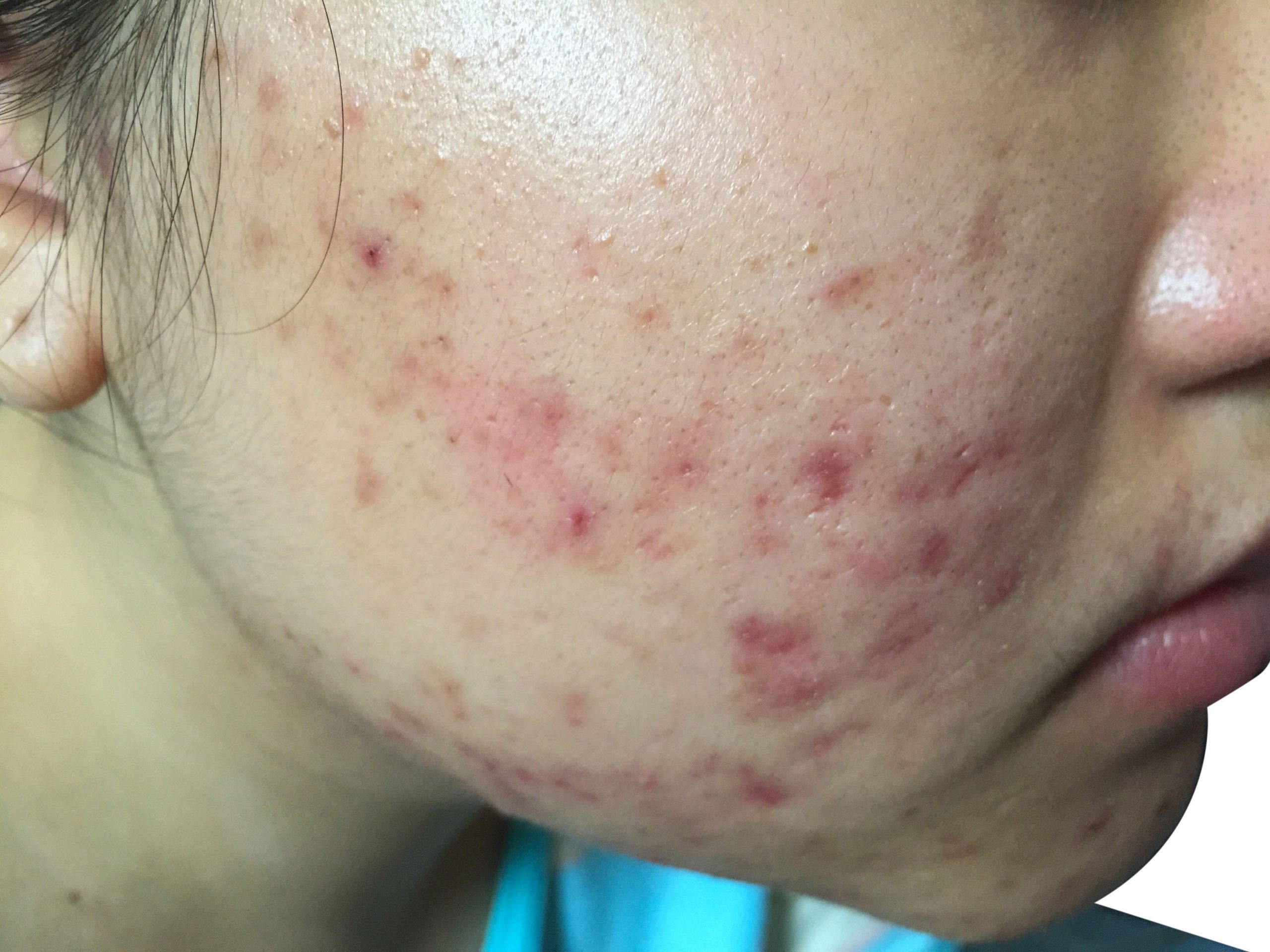 phage therapy acne