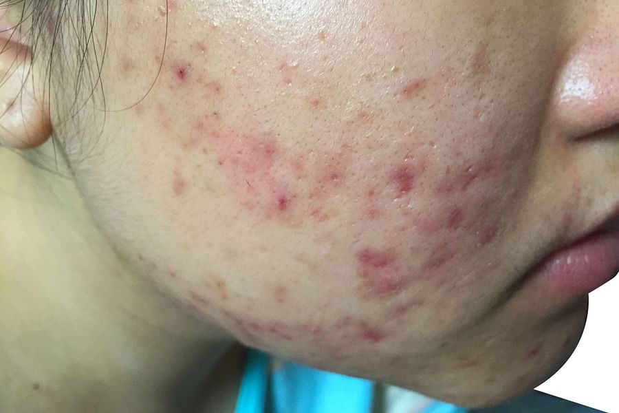 phage therapy acne