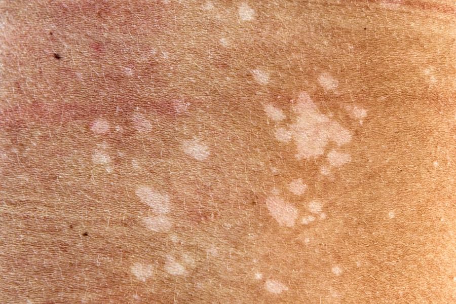 Miniature Spot Patches